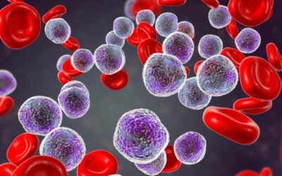 Nove em 10 ignoram: os sinais iniciais dessa leucemia